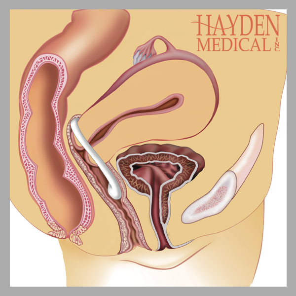 Hodge Pessary inserted